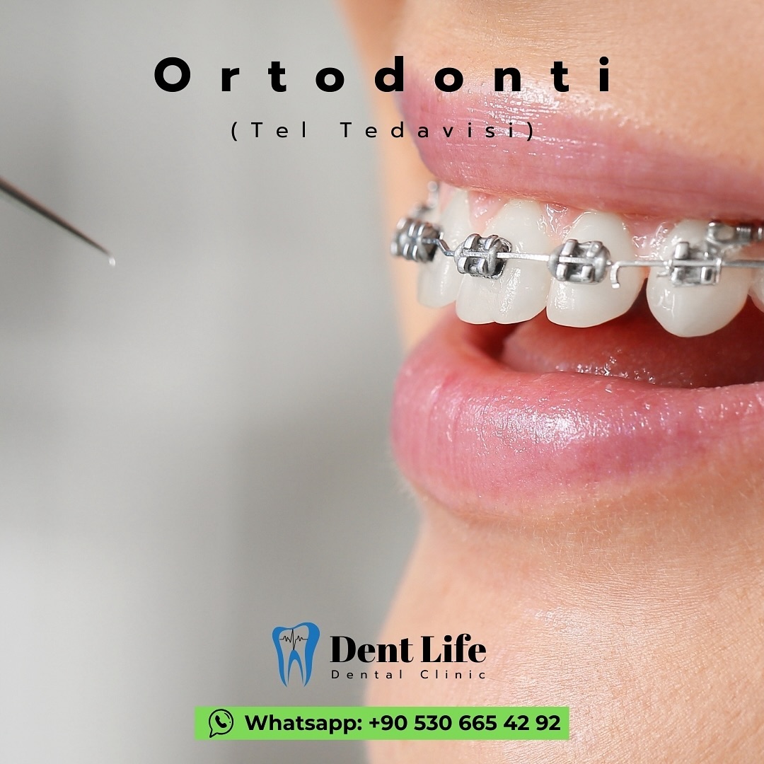 Tel Tedavisi (Ortodontik Tedavi) - Sağlıklı ve Estetik Bir Gülüş
