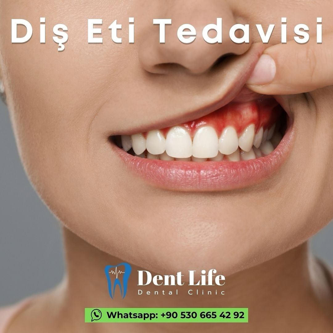 Diş Eti Tedavisi
