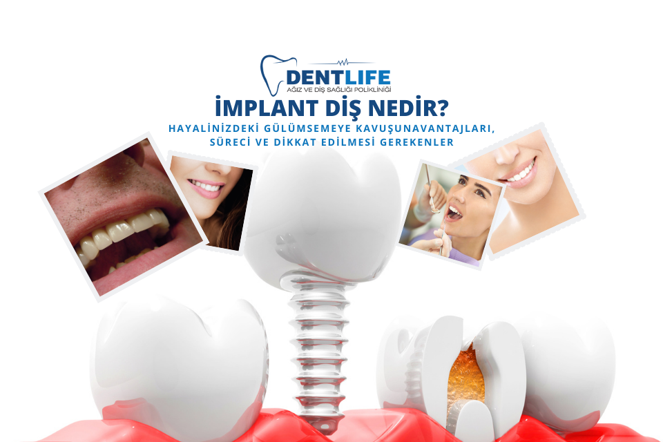 İmplant Diş Nedir? Avantajları, Süreci ve Dikkat Edilmesi Gerekenler