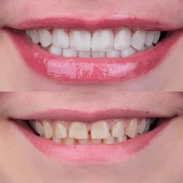 Zirkonyum Kaplama Kampanyası